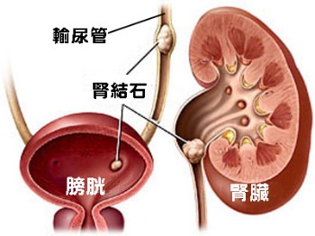 腎結石