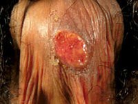 梅毒圖片 泰安中醫主治 梅毒症狀 梅毒玫瑰疹